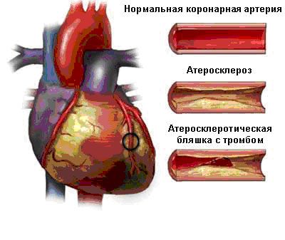 Острый коронарный синдром стенокардия инфаркт миокарда