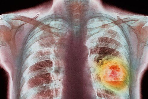 Какие заболевания легких могут быть без кашля