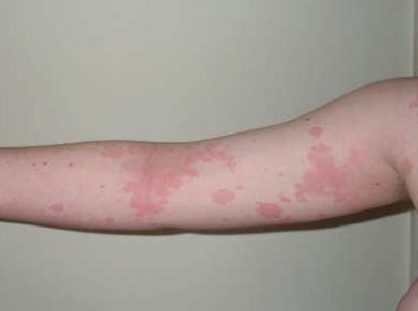 Чем лечить аллергию на коже от лекарств