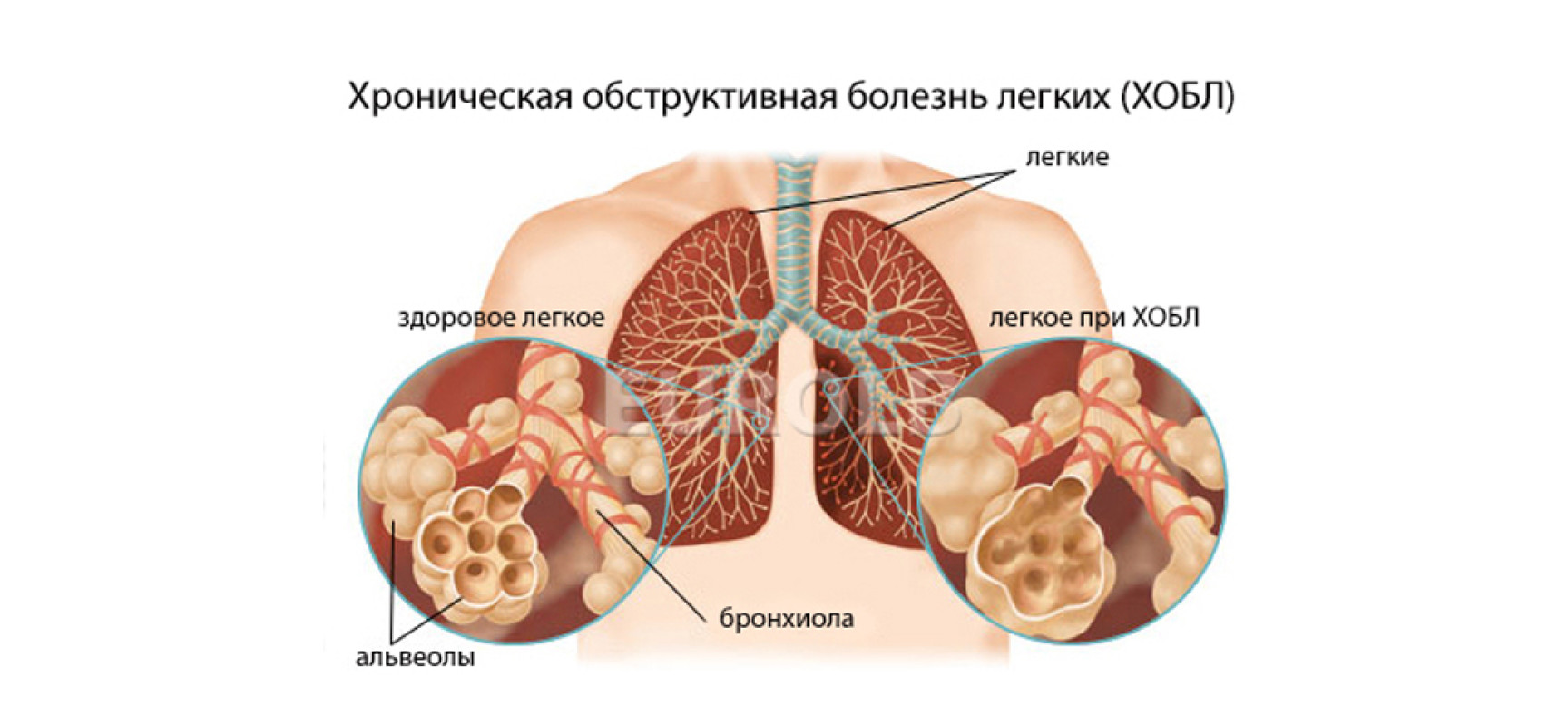 Какие болезни легких передаются от человека к человеку
