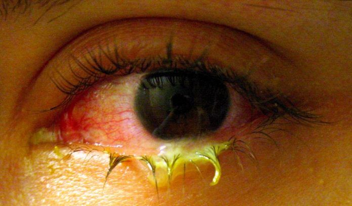 Фото глаза с бактериальным конъюнктивитом