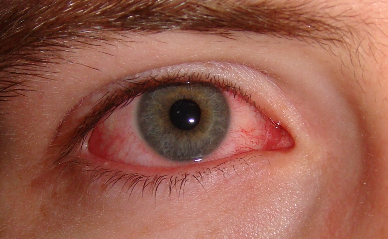 Болезни глаз конъюнктивит фото thumbnail