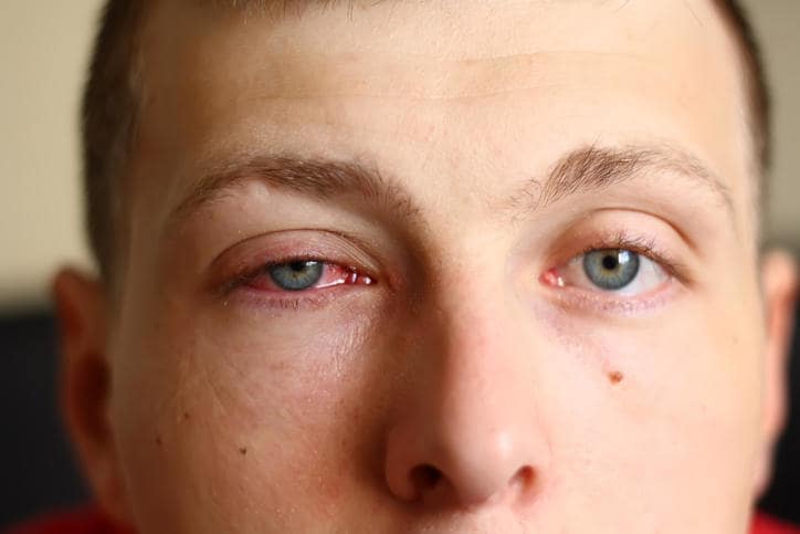 Болезнь глаз конъюнктивит фото лечение