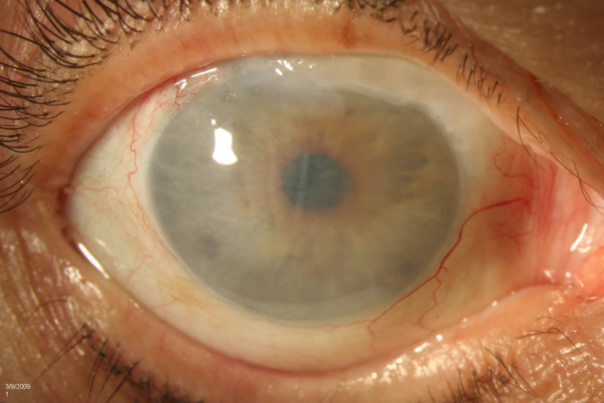 Отек эпителия роговицы глаза