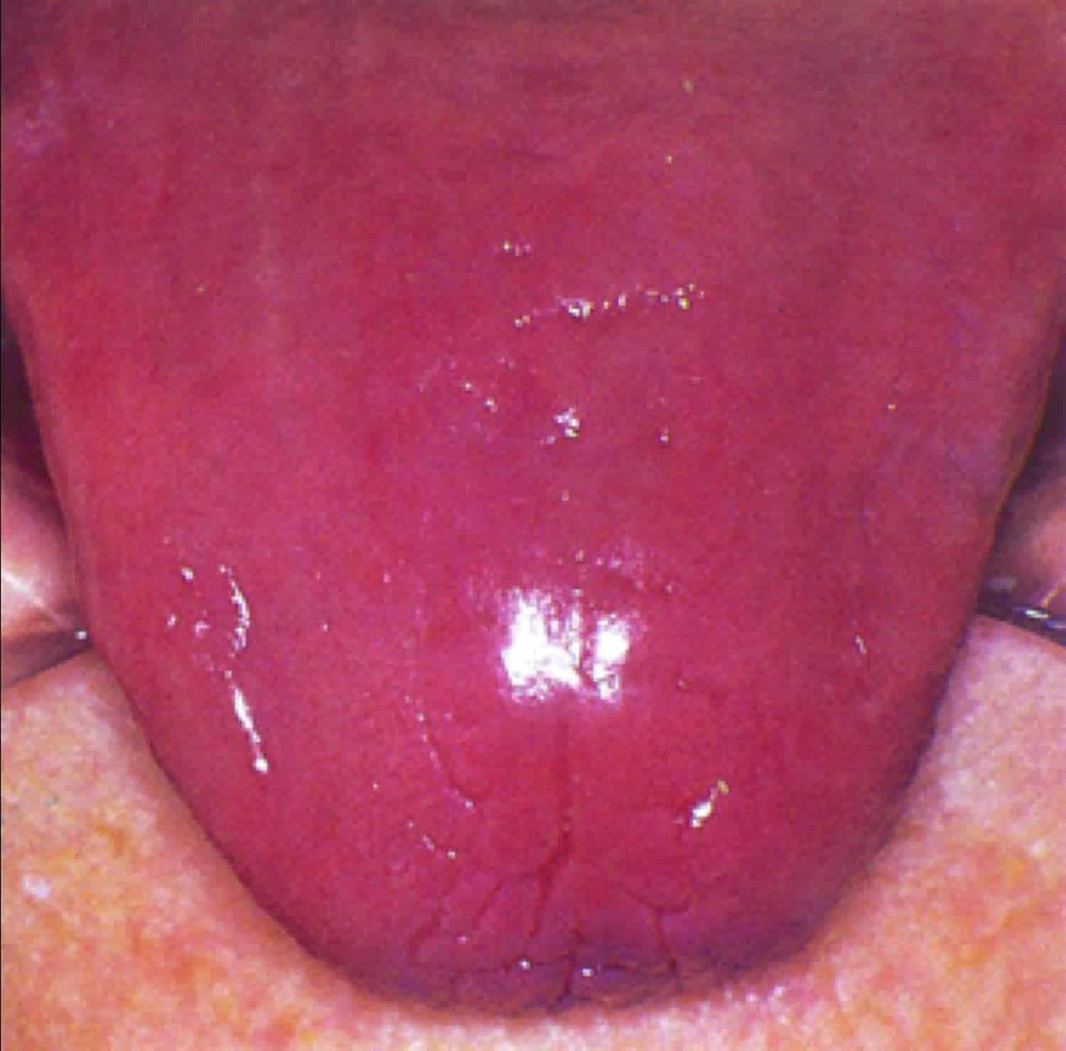 Симптомы пернициозной анемии у женщин и фото