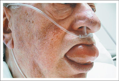 Что такое ангионевротический отек носа