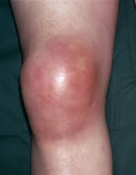 Жидкость в коленном суставе как называется болезнь