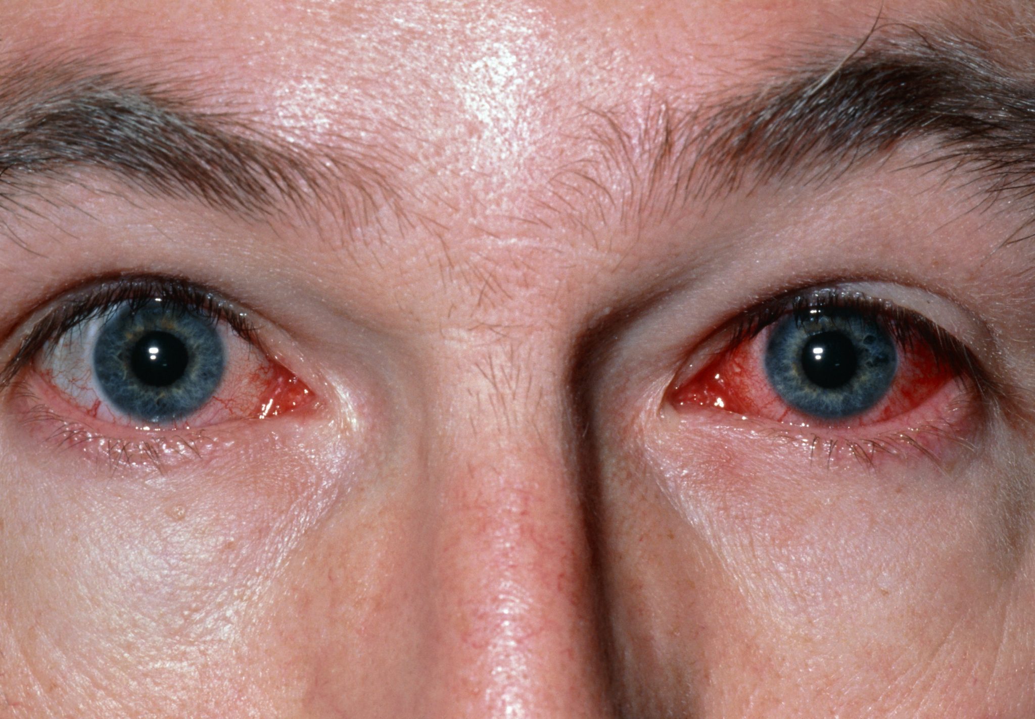 Светобоязнь глаз причины и лечение фото