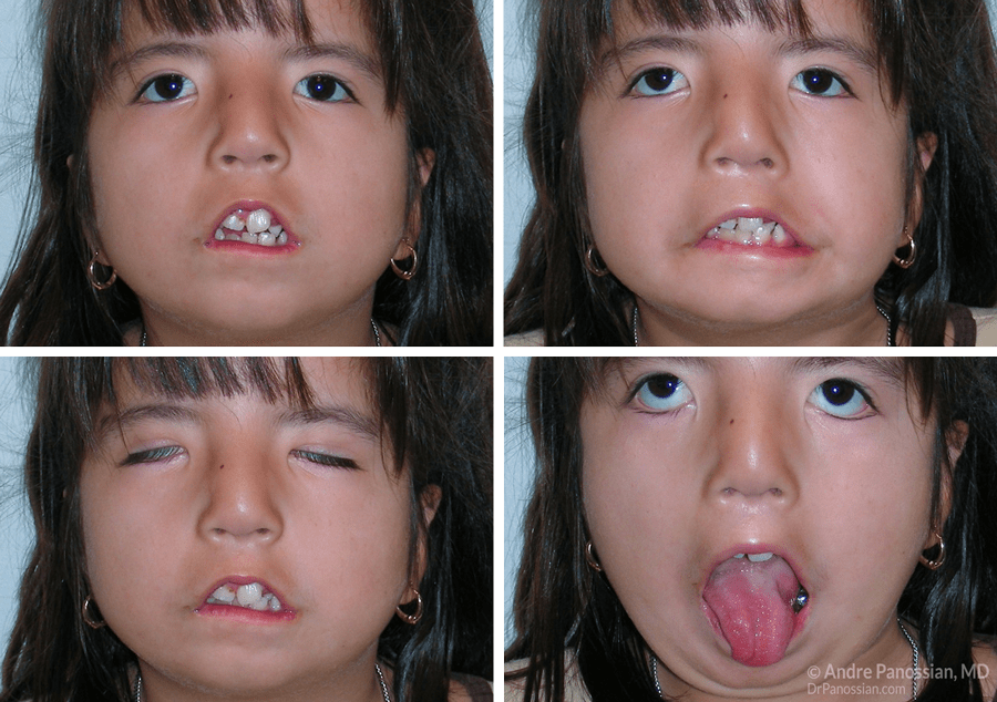 Фото детей с синдромом мебиуса