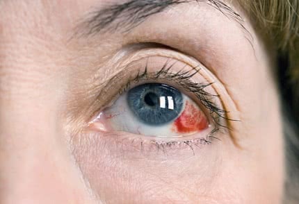 Лечение разрыва капилляров в глазу