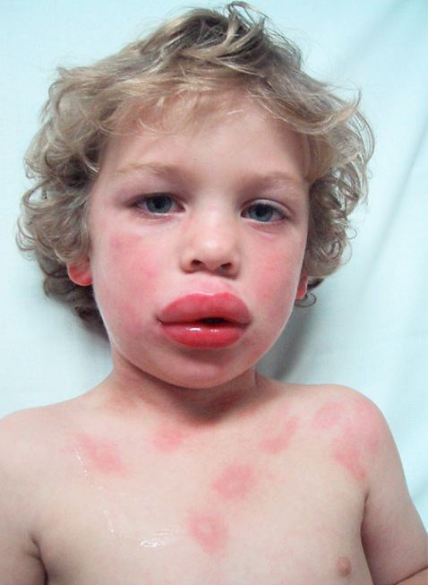 Аллергия на цитрусовые сыпь фото