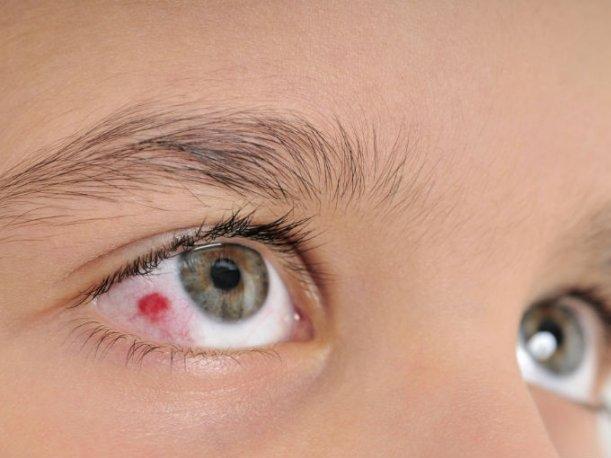 Лечение разрыва капилляров в глазу