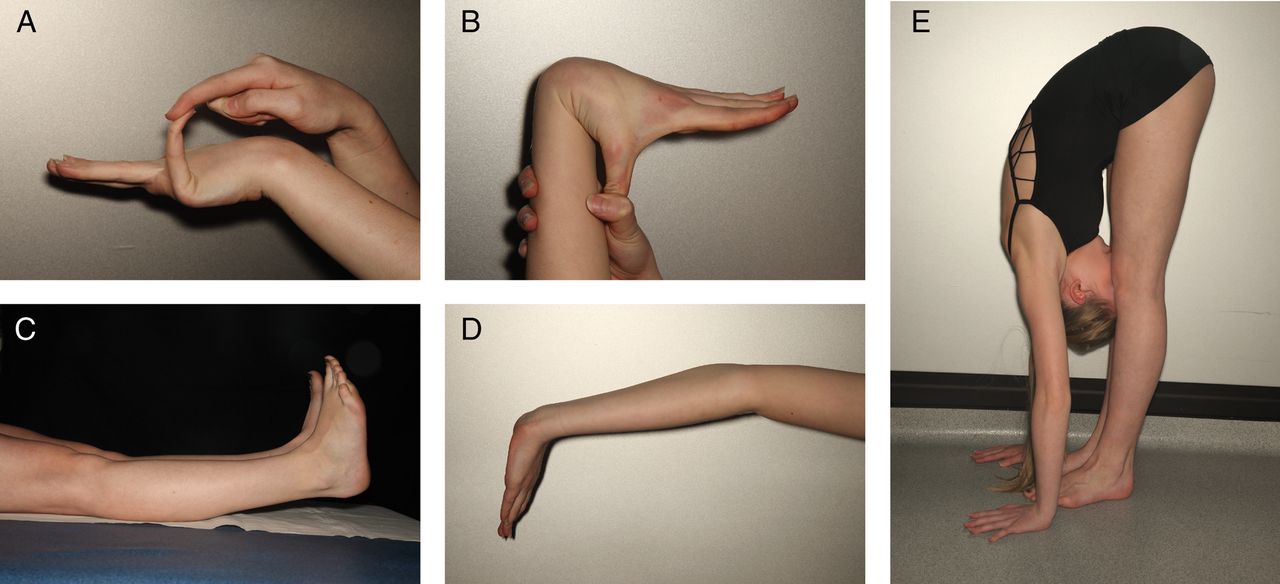 Синдром гипермобильности суставов на фоне мышечной гипотонии лечение
