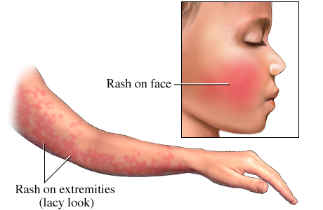 Инфекционная эритема или краснуха