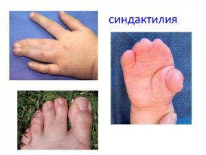 Синдром шерешевского тернера с фото