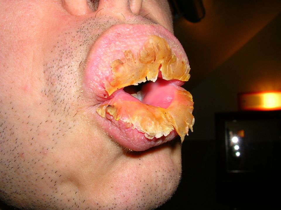 Воспаление красной каймы губ лечение