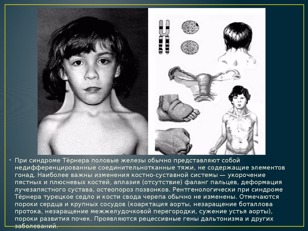 Синдром шерешевского тернера с фото